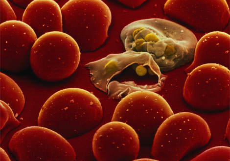 Plasmodium falciparum attacking blood cells